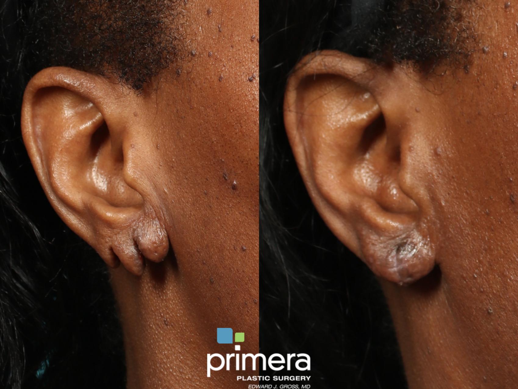 Before & After Facial Scarring Case 637 Right Side View in Orlando, Florida