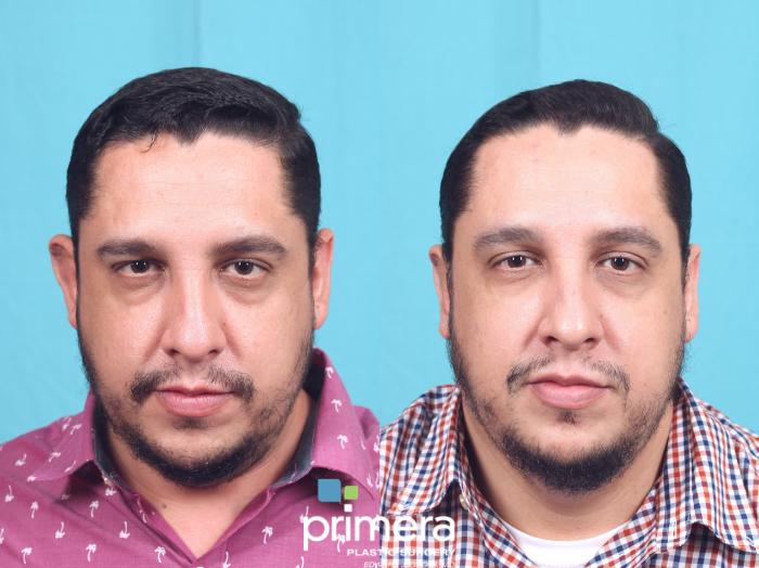 Before & After Surgery for Men Case 655 Front View in Orlando, Florida
