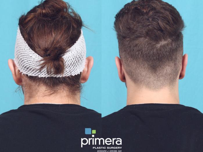 Before & After Ear Surgery (Otoplasty) Case 717 Back View in Orlando, Florida