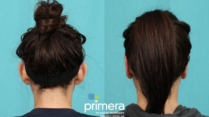 Before & After Ear Surgery (Otoplasty) Case 757 Back View in Orlando, Florida