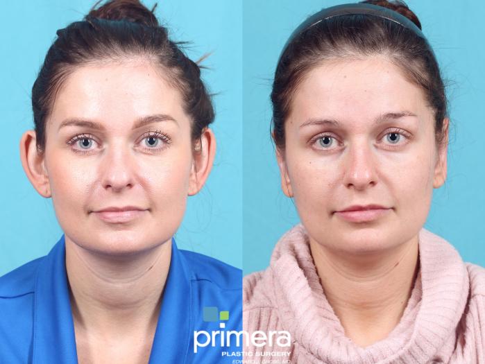 Before & After Ear Surgery (Otoplasty) Case 757 Front View in Orlando, Florida