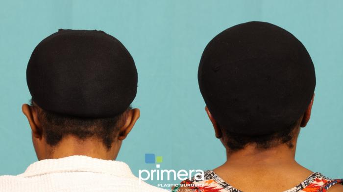 Before & After Ear Surgery (Otoplasty) Case 758 Back View in Orlando, Florida
