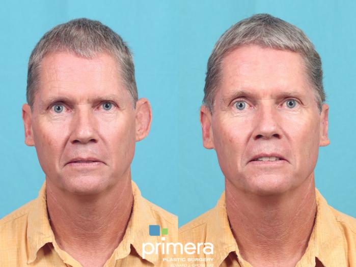 Before & After Ear Surgery (Otoplasty) Case 843 Front View in Orlando, Florida