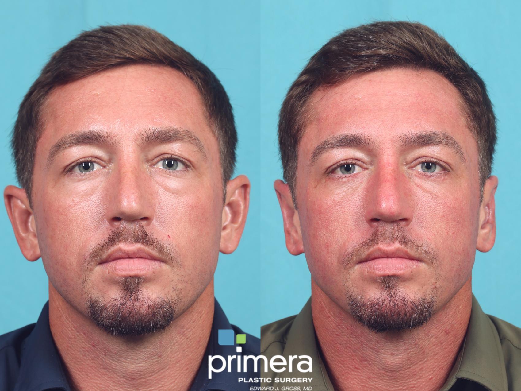 Before & After Ear Surgery (Otoplasty) Case 855 Front View in Orlando, Florida
