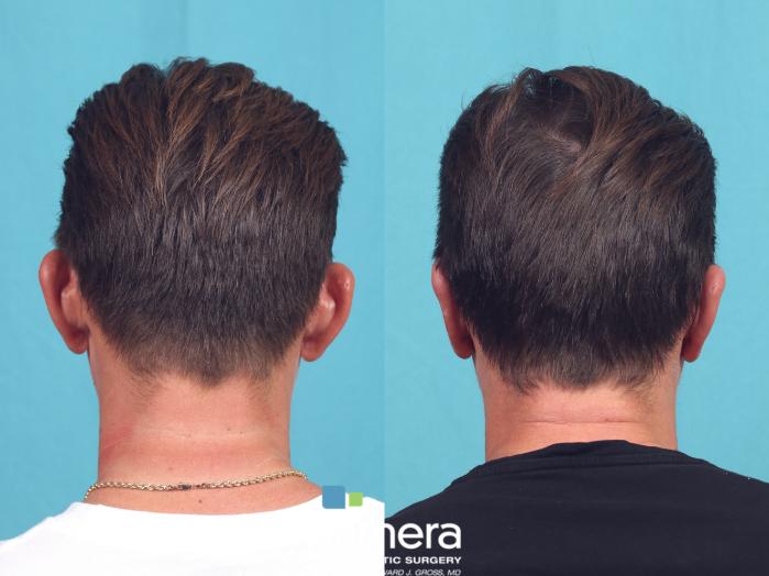 Before & After Ear Surgery (Otoplasty) Case 861 Back View in Orlando, Florida