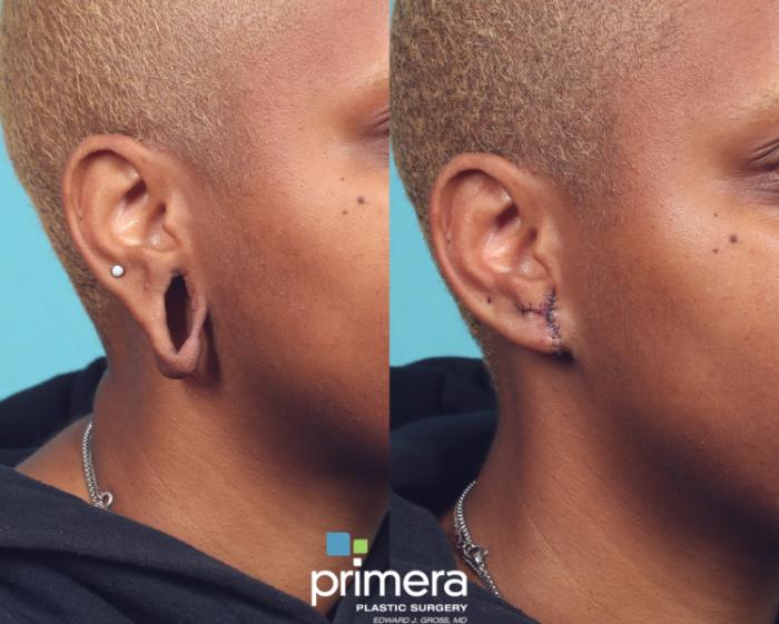 Before & After Ear Surgery (Otoplasty) Case 875 Right Side View in Orlando, Florida