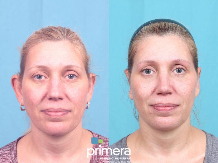 Before & After Ear Surgery (Otoplasty) Case 881 Front View in Orlando, Florida