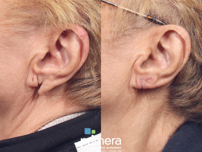 Before & After Facial Scarring Case 948 Left Side View in Orlando, Florida