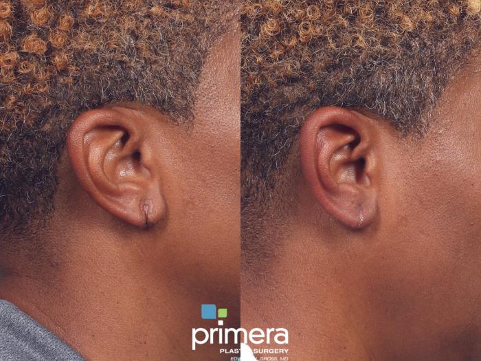Before & After Facial Scarring Case 954 Right Side View in Orlando, Florida
