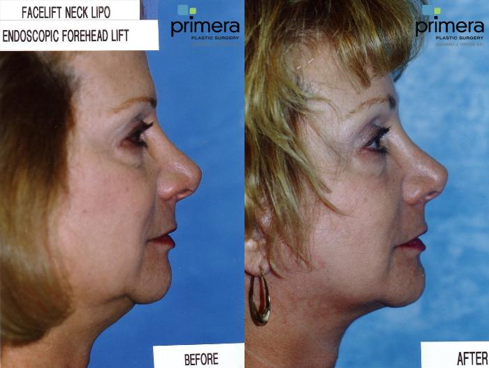 Before & After Endoscopic Forehead Lift Case 134 view-1 View in Orlando, Florida