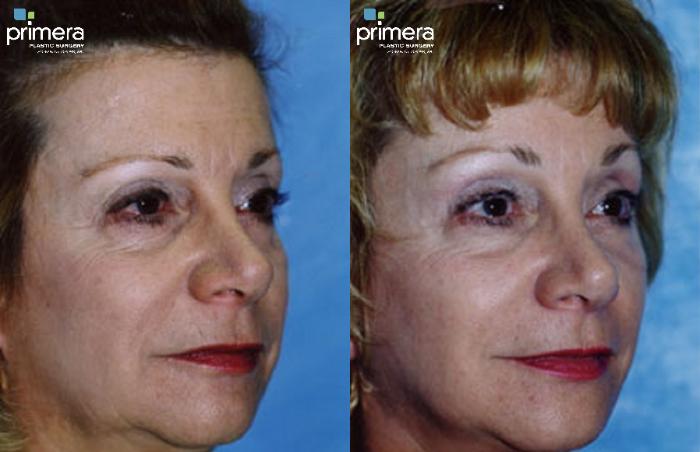 Before & After Endoscopic Forehead Lift Case 134 view-2 View in Orlando, Florida