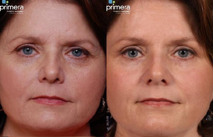 Before & After Endoscopic Forehead Lift Case 260 view-1 View in Orlando, Florida