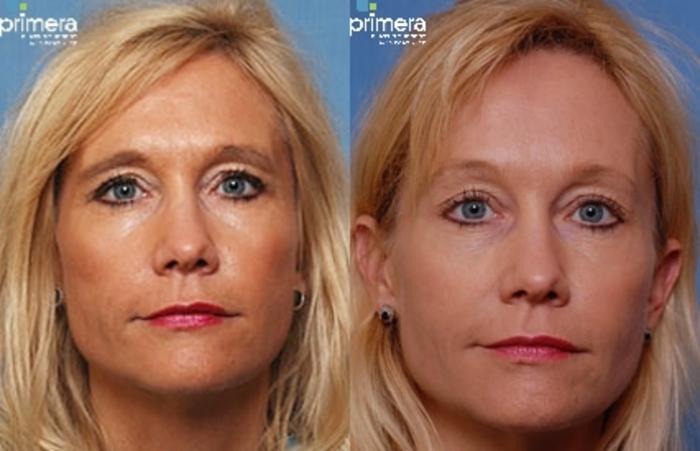 Before & After BOTOX® Cosmetic Case 27 view-1 View in Orlando, Florida