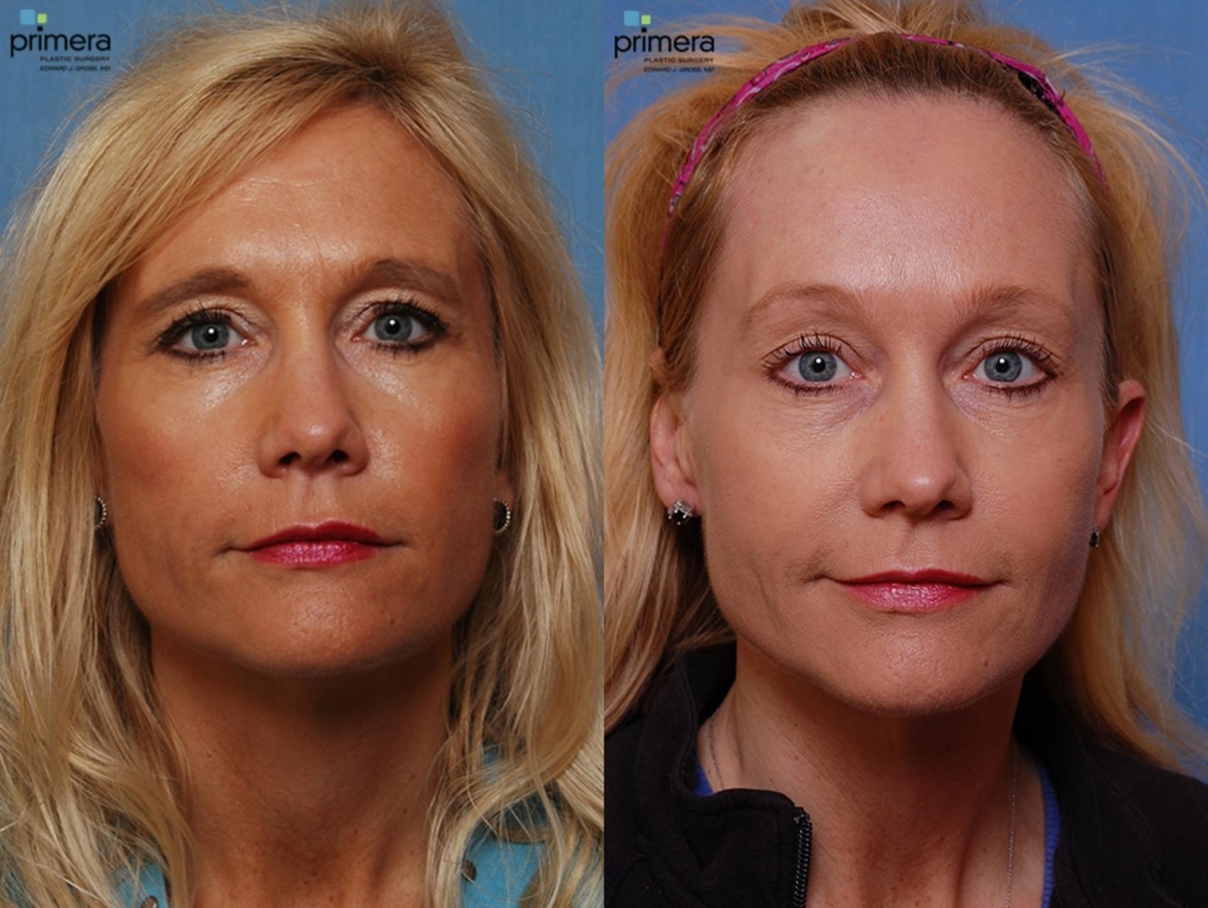 Endoscopic Forehead Lift Before and After Pictures Case 27 Orlando