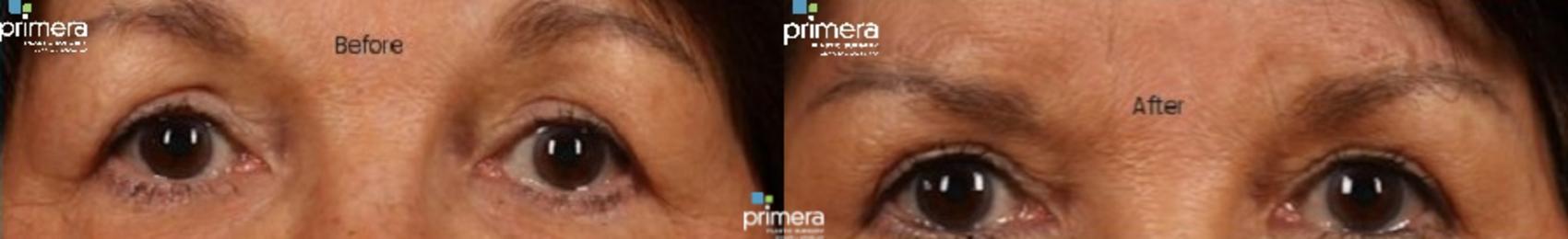 Before & After Endoscopic Forehead Lift Case 282 view-1 View in Orlando, Florida