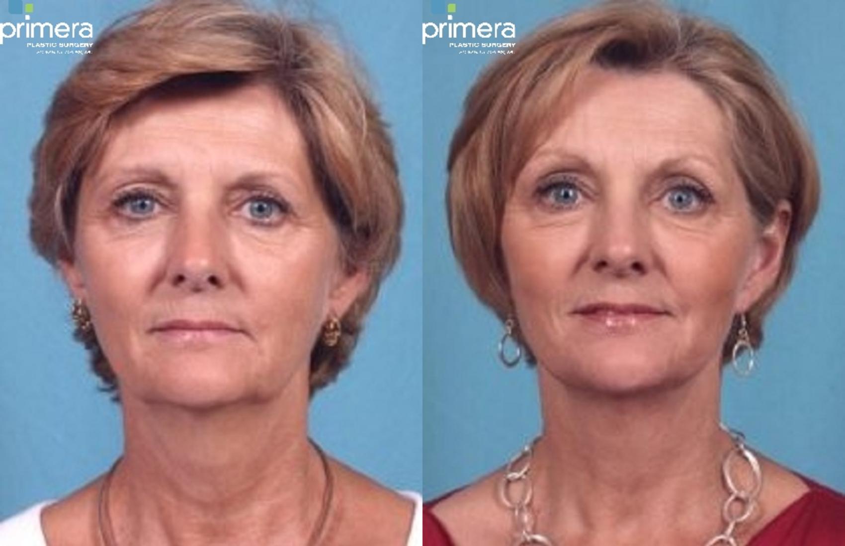 Before & After Endoscopic Forehead Lift Case 283 view-1 View in Orlando, Winter Park & Tampa, Florida