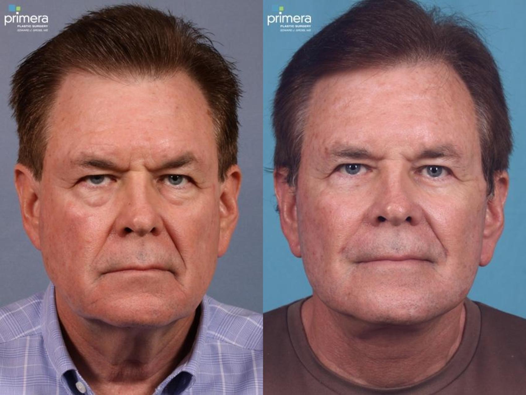 Before & After Surgery for Men Case 441 view-1 View in Orlando, Florida