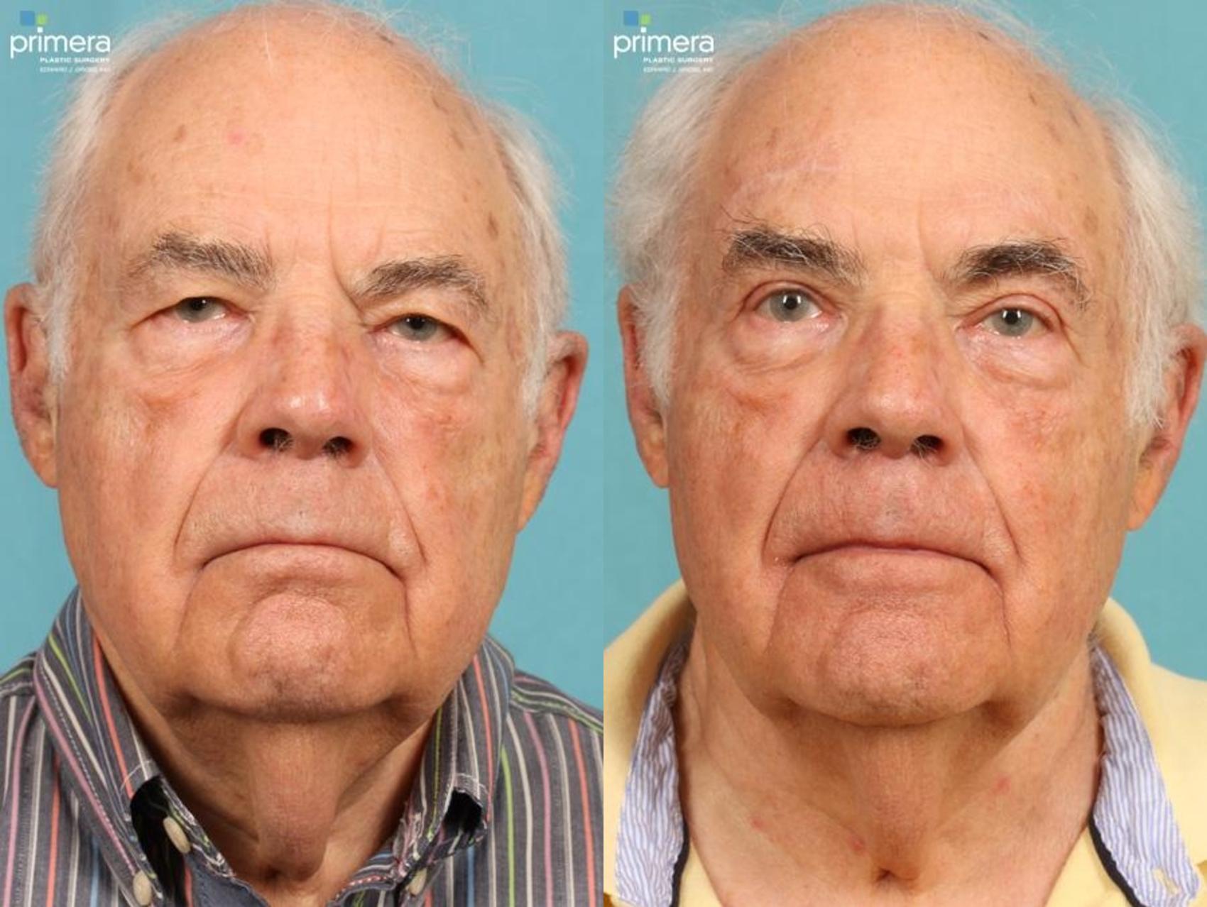 Before & After Blepharoplasty Case 442 view-1 View in Orlando, Florida