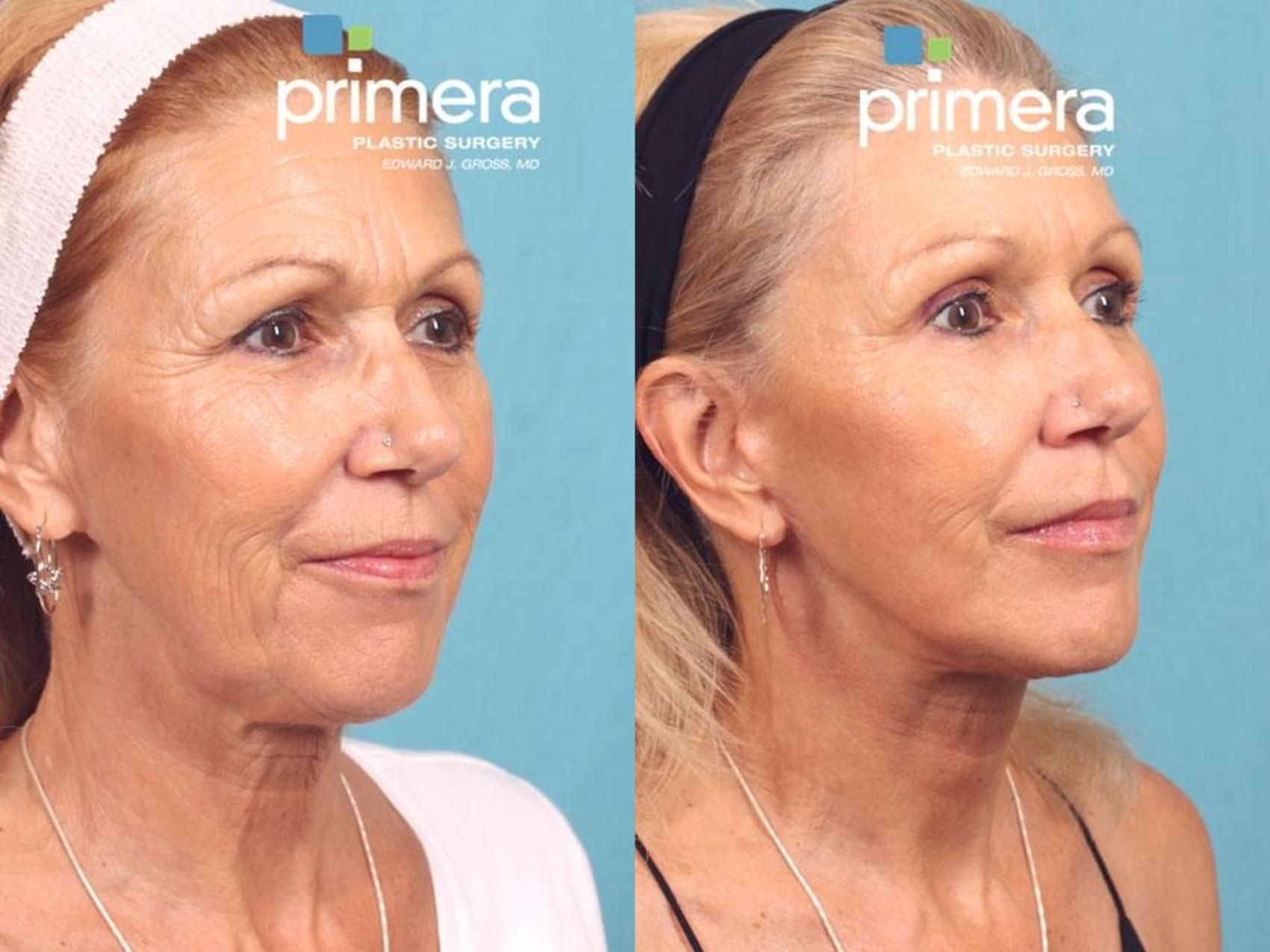Before & After Endoscopic Forehead Lift Case 570 view-1 View in Orlando, Florida