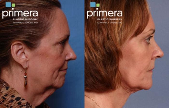 Before & After Neck Lift Case 105 view-1 View in Orlando, Florida