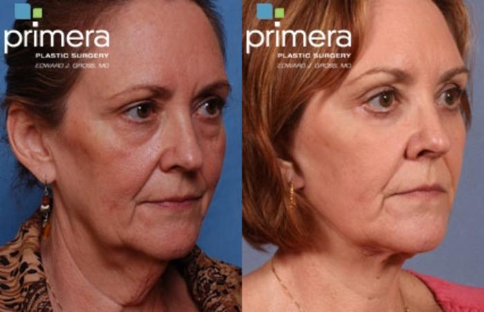 Before & After Facelift Case 105 view-2 View in Orlando, Florida