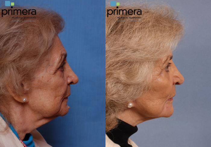 Before & After Facelift Case 108 view-1 View in Orlando, Florida
