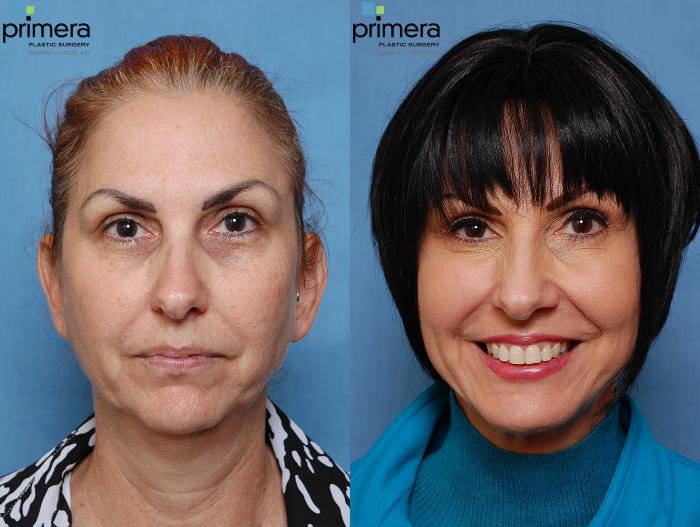 Before & After Blepharoplasty Case 114 view-1 View in Orlando, Florida