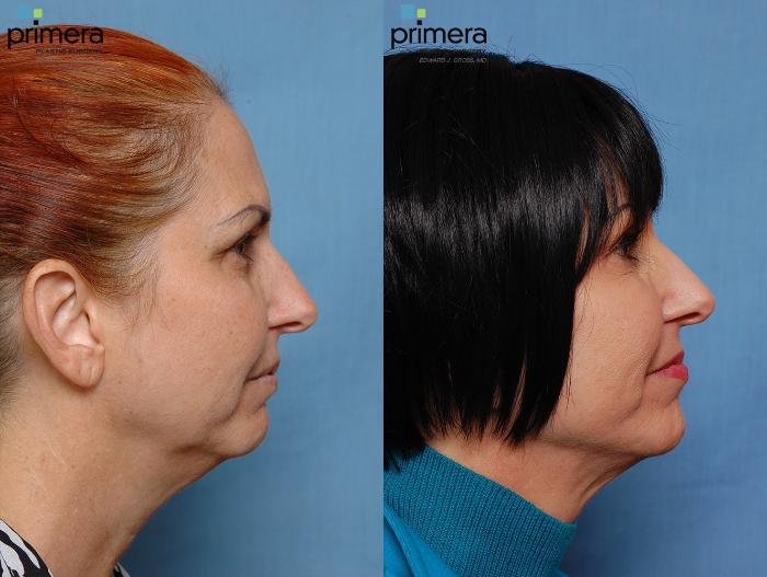 Before & After Blepharoplasty Case 114 view-2 View in Orlando, Florida