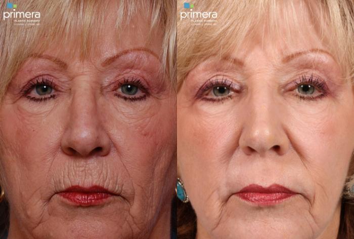 Before & After Blepharoplasty Case 118 view-1 View in Orlando, Florida