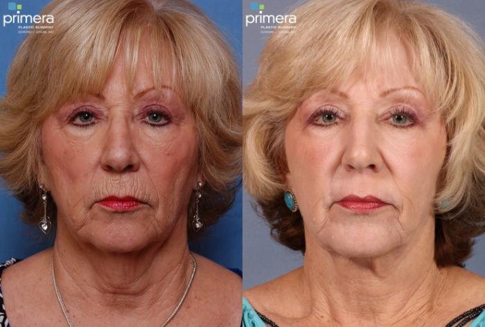 Before & After Blepharoplasty Case 118 view-2 View in Orlando, Florida