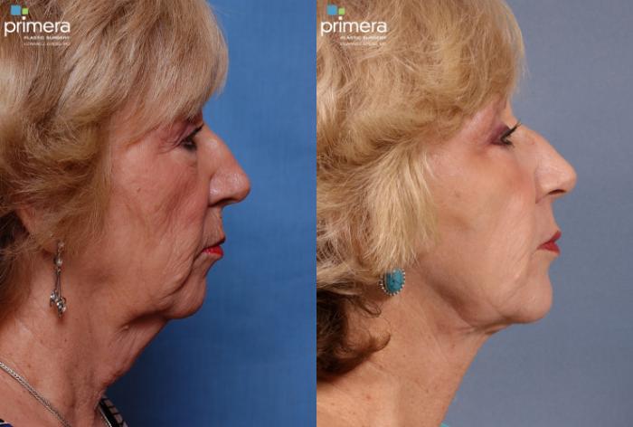 Before & After Facelift Case 118 view-3 View in Orlando, Florida