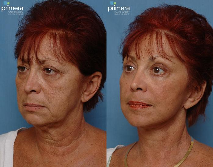 Before & After Fat Grafting Case 119 view-1 View in Orlando, Florida