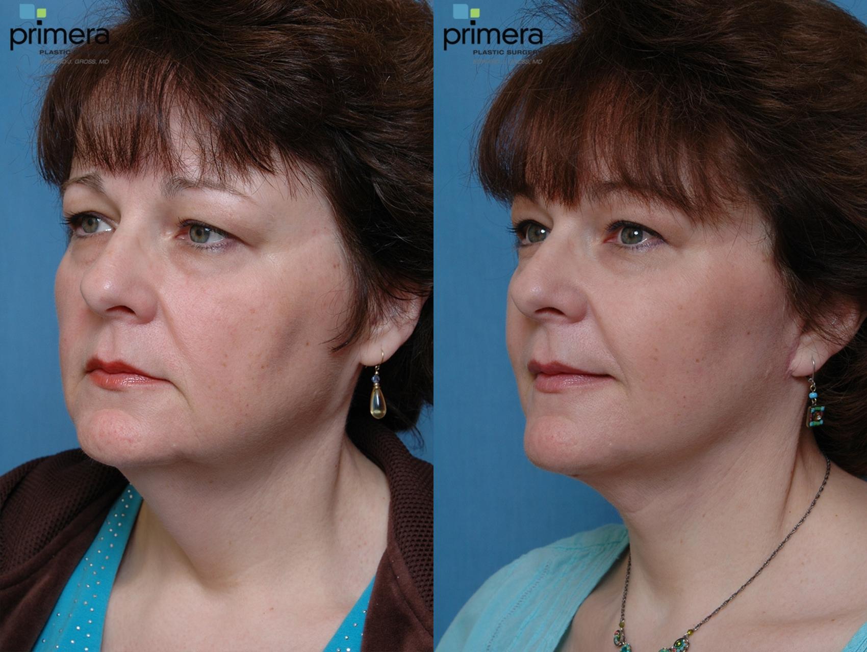 Before & After Facelift Case 127 view-1 View in Orlando, Florida
