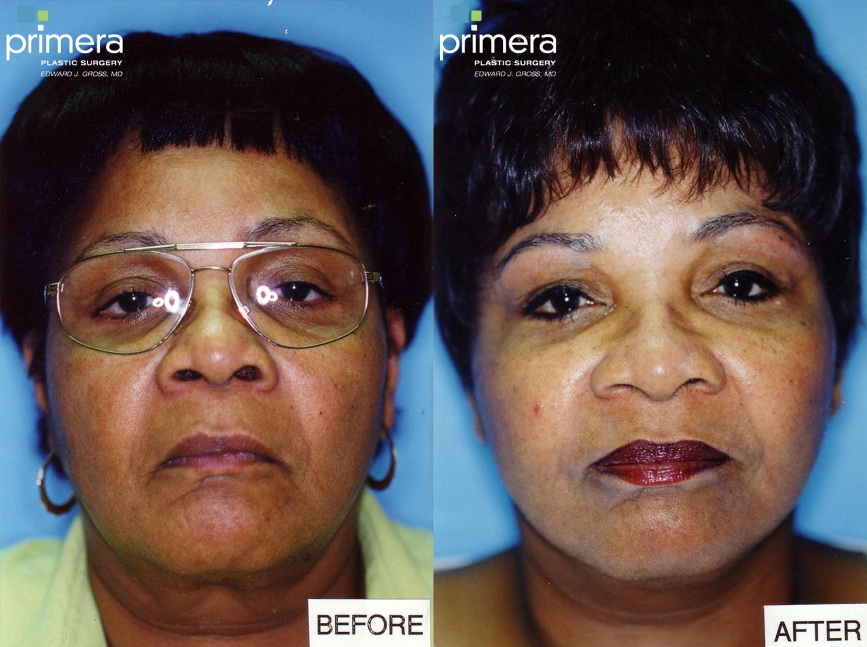 Before & After Neck & Face Liposuction Case 130 view-1 View in Orlando, Florida
