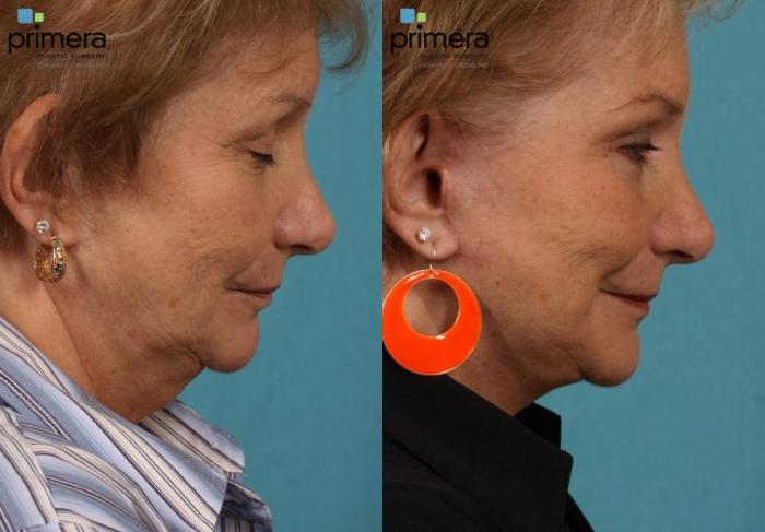 Before & After Neck & Face Liposuction Case 141 view-1 View in Orlando, Florida