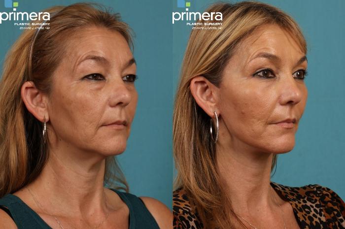 Before & After Blepharoplasty Case 199 view-1 View in Orlando, Florida