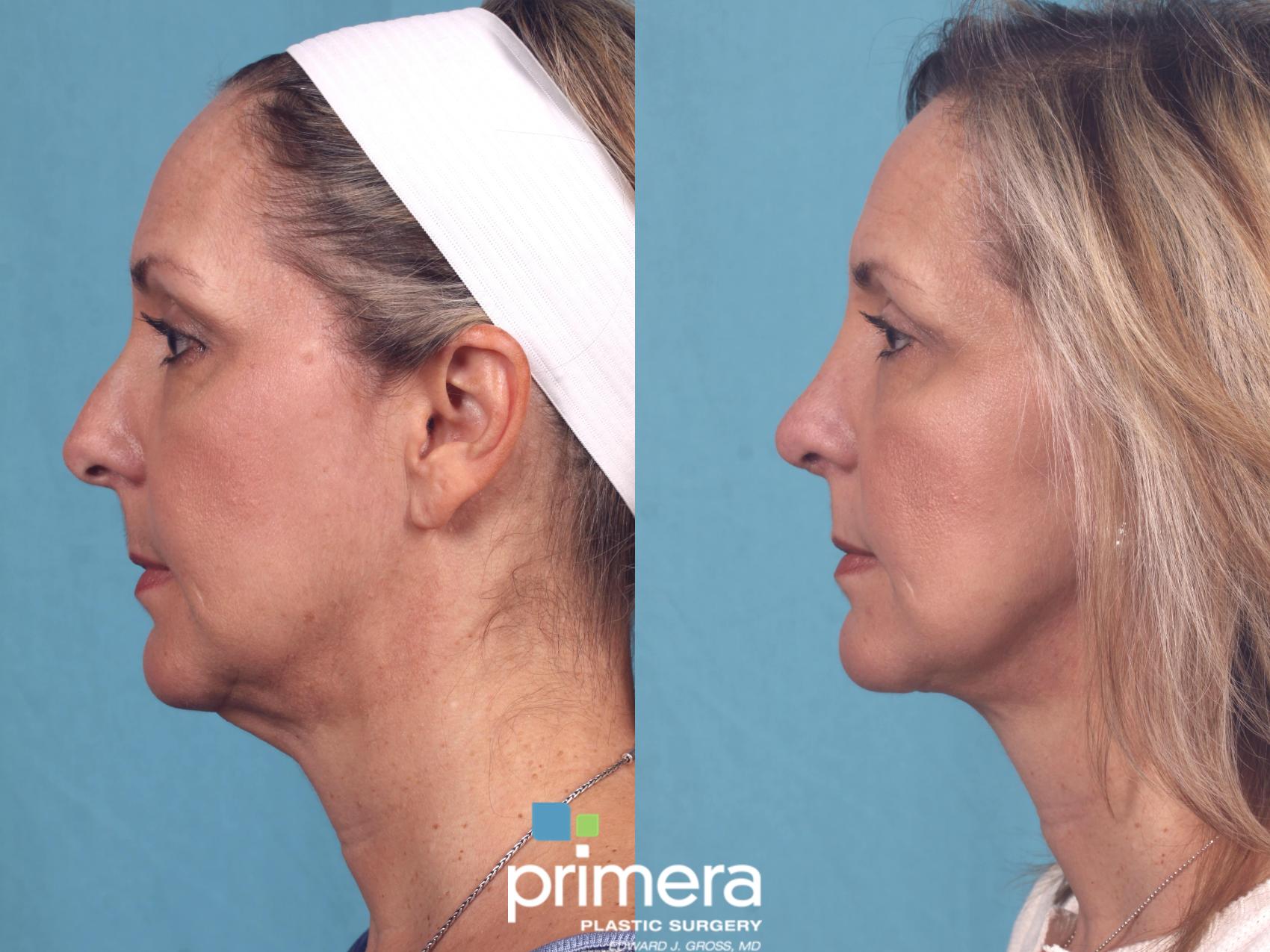 Before & After Rhinoplasty Case 204 view-1 View in Orlando, Florida