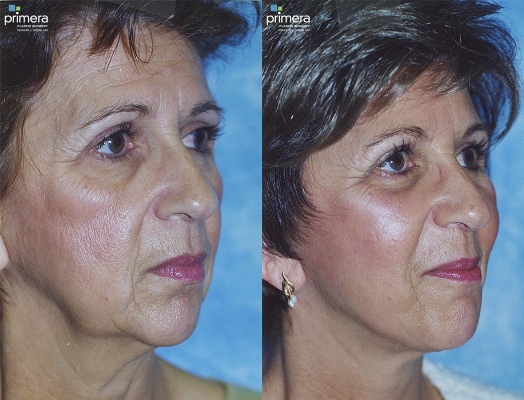 Before & After Facelift Case 25 view-1 View in Orlando, Florida