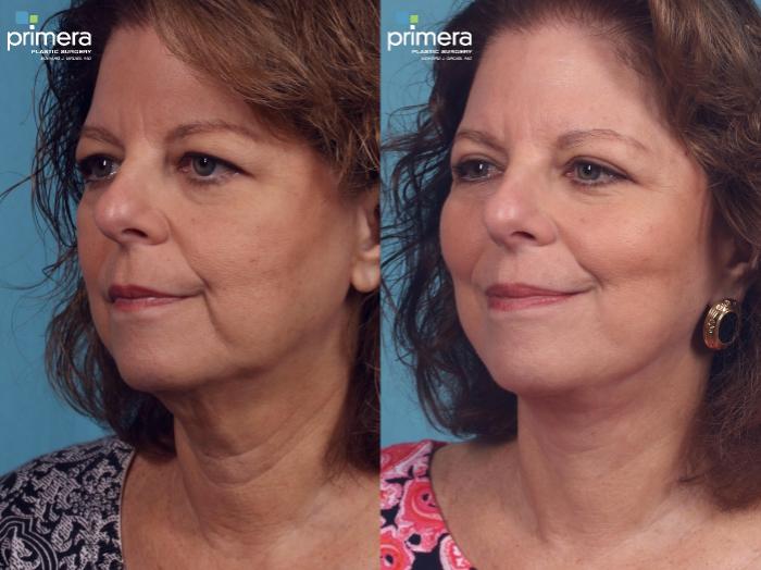 Before & After Blepharoplasty Case 259 view-1 View in Orlando, Florida