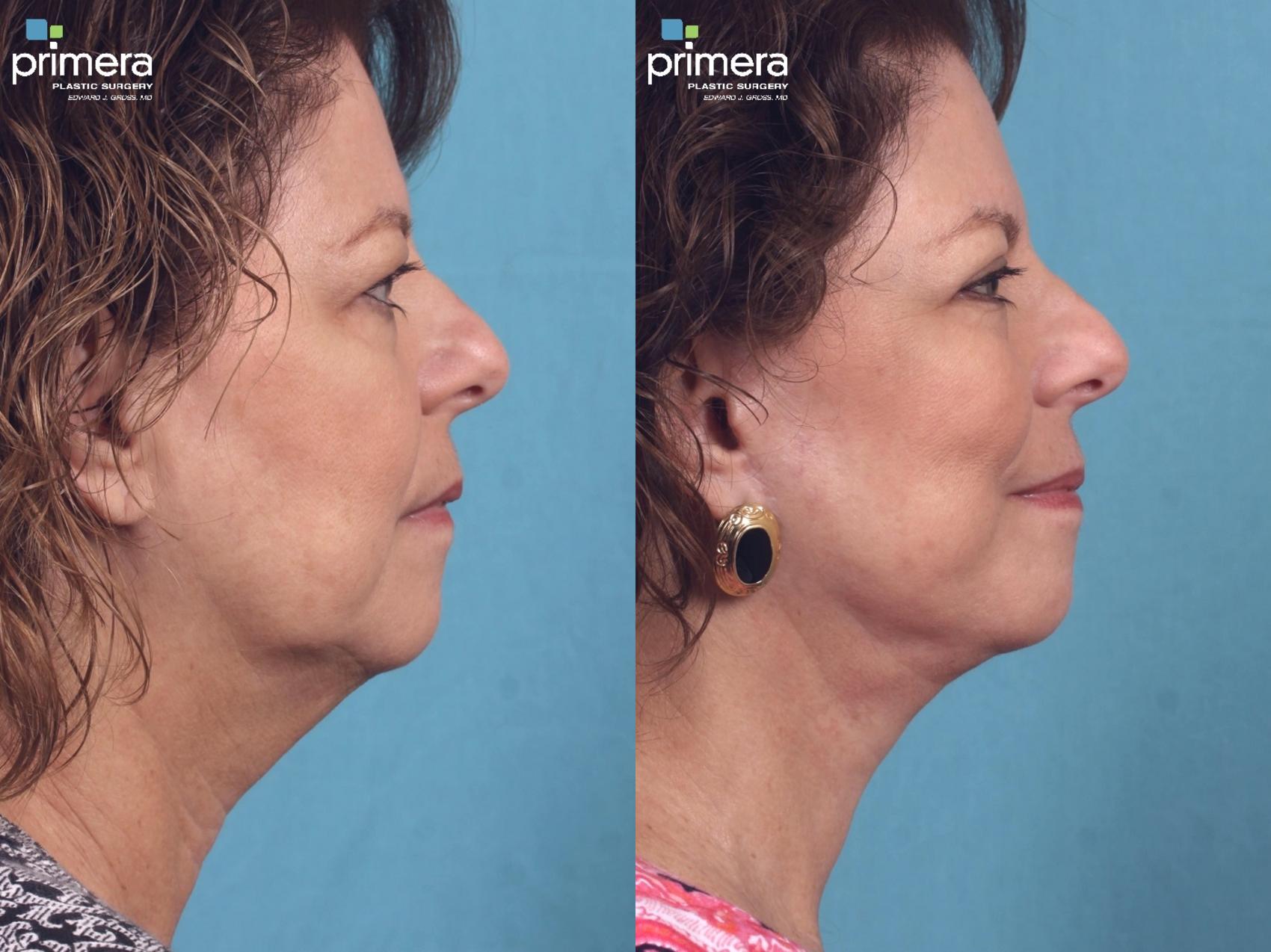 Facelift Before and After Pictures Case 259 Orlando, Florida
