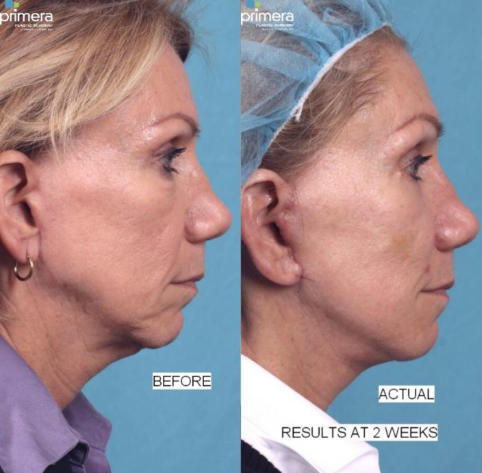 Before & After Fat Grafting Case 290 view-1 View in Orlando, Florida