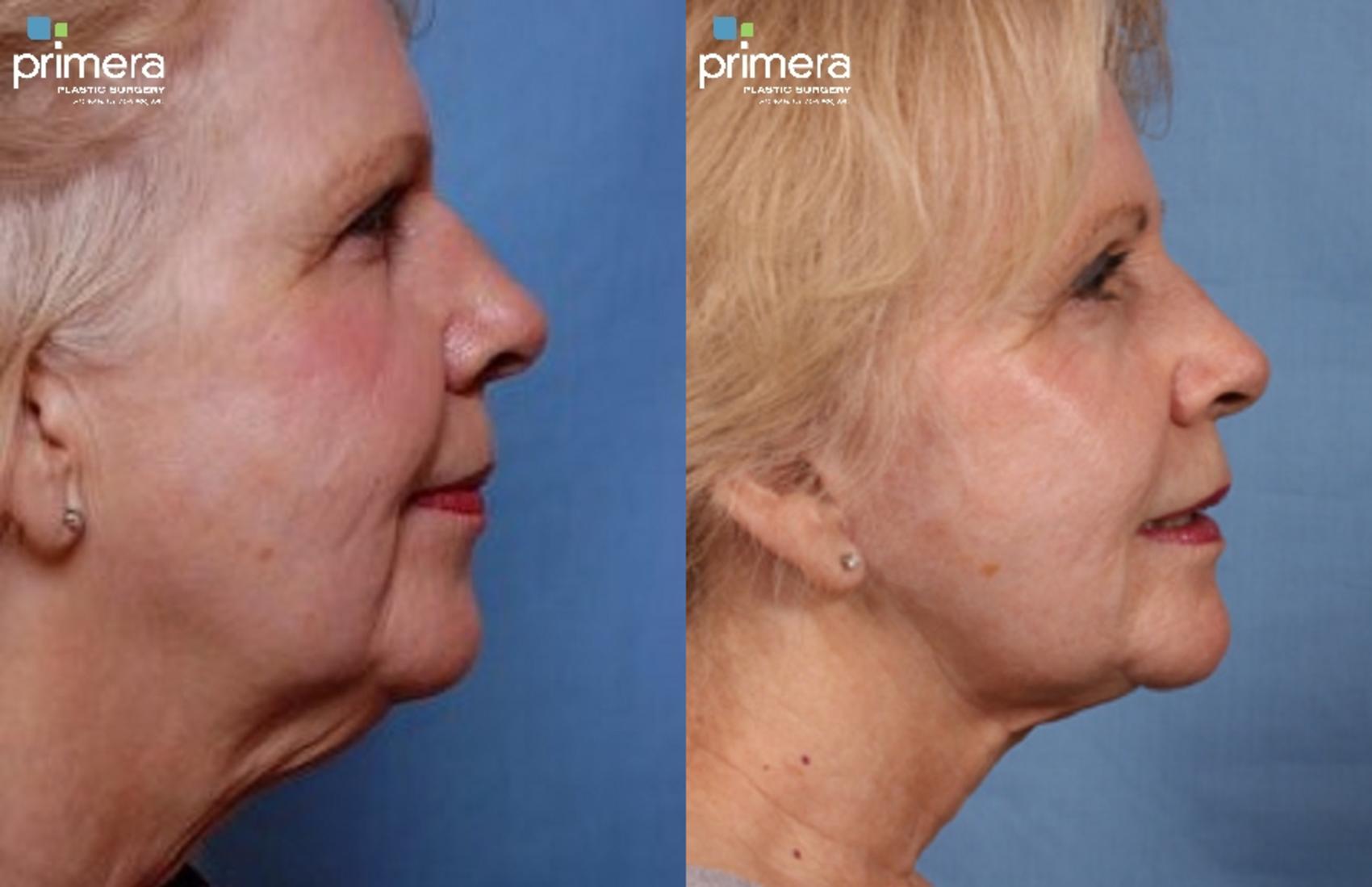 Before & After Neck Lift Case 302 view-1 View in Orlando, Florida