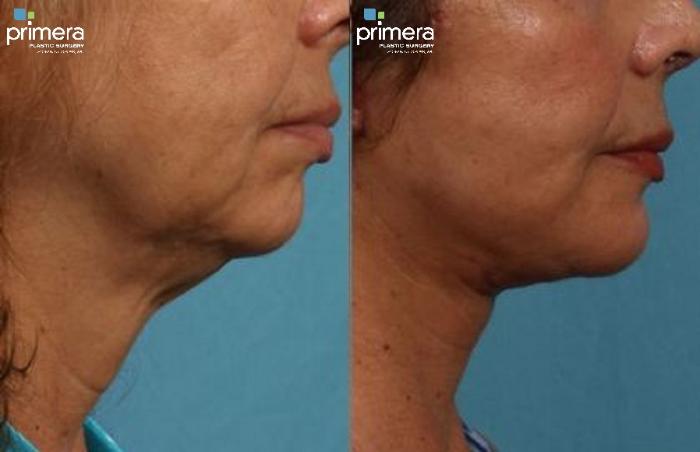 Before & After Neck Lift Case 303 view-1 View in Orlando, Florida