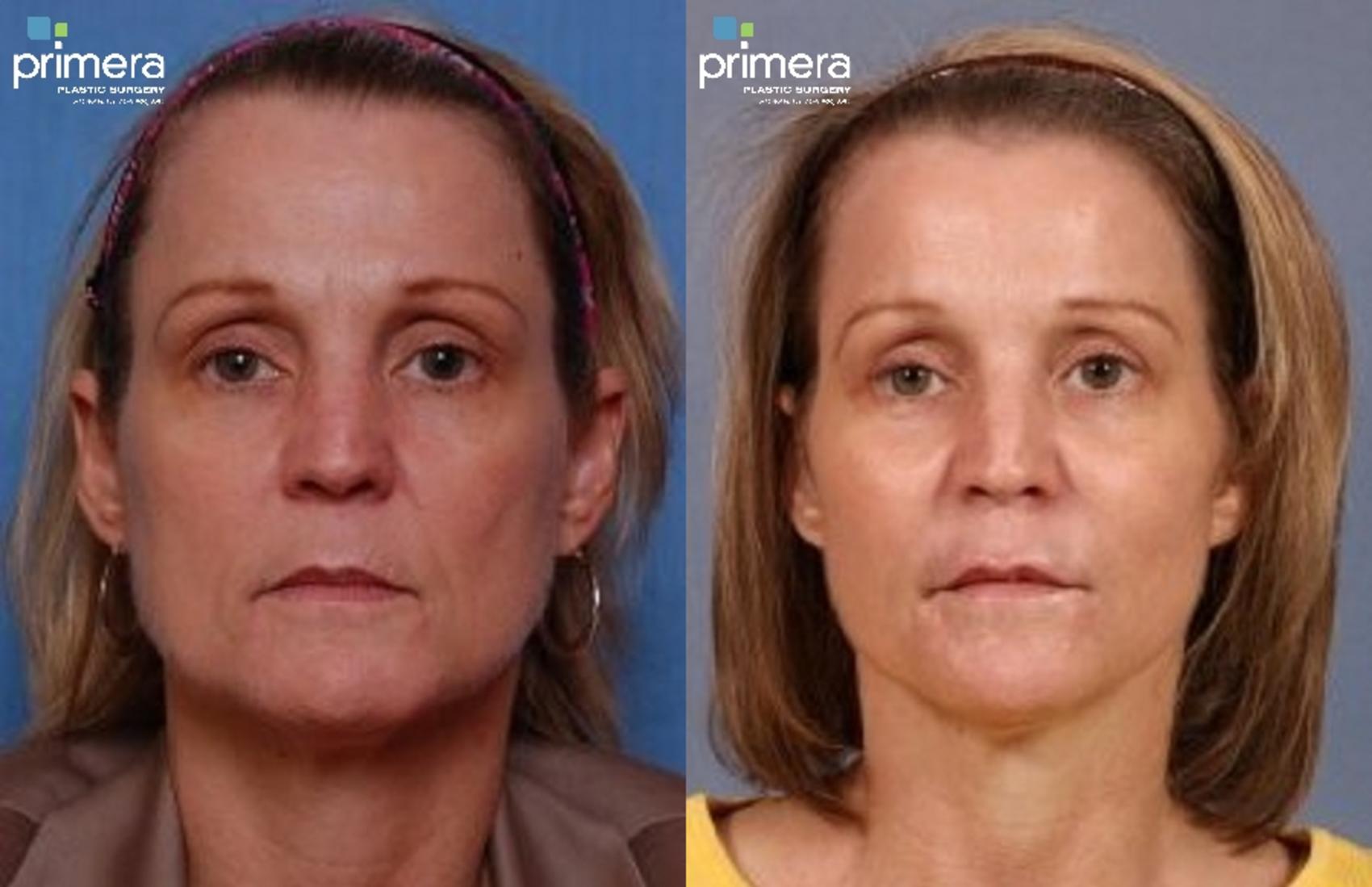 Before & After Facelift Case 306 view-1 View in Orlando, Florida