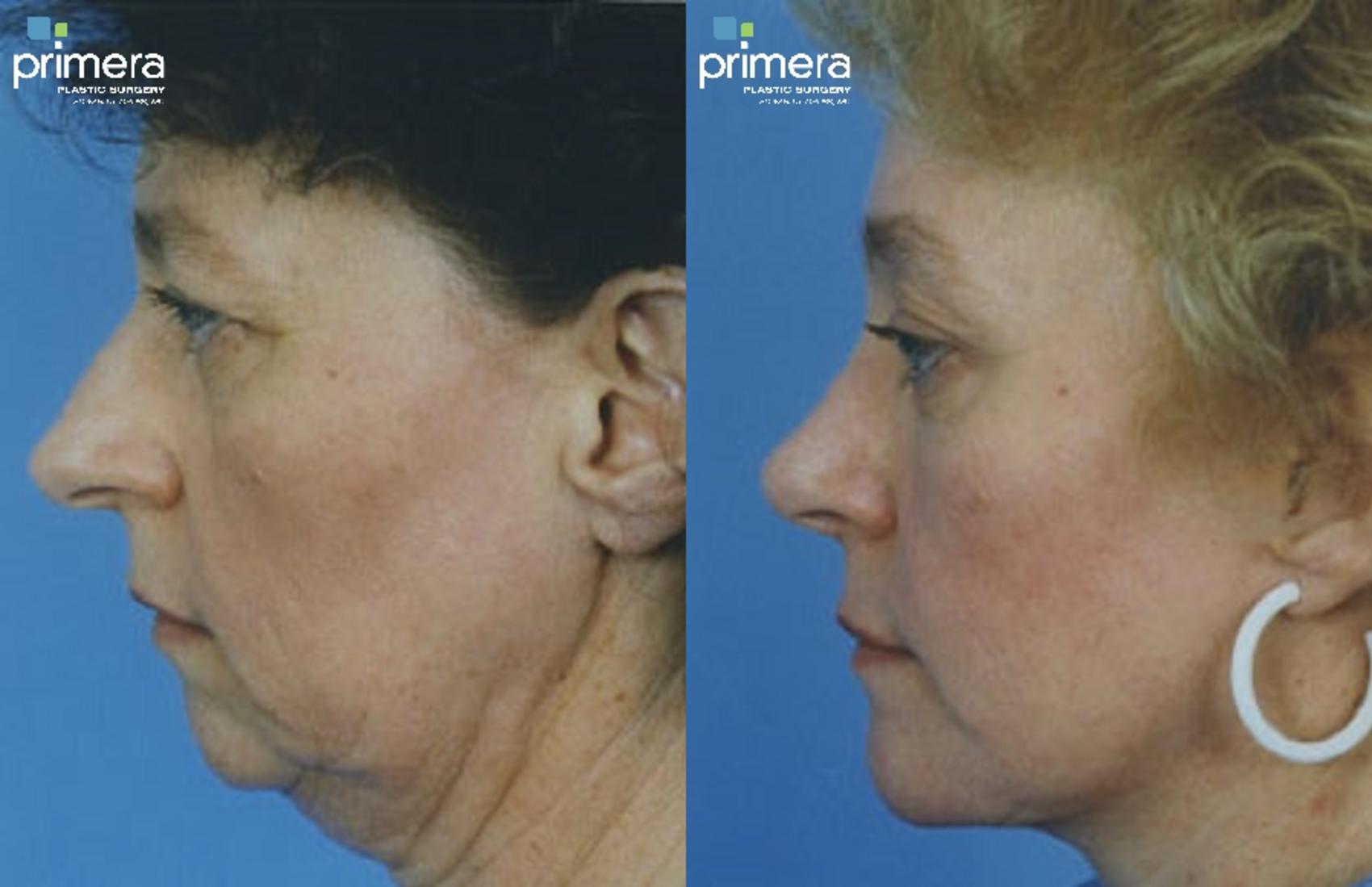 Before & After Rhinoplasty Case 310 view-1 View in Orlando, Florida