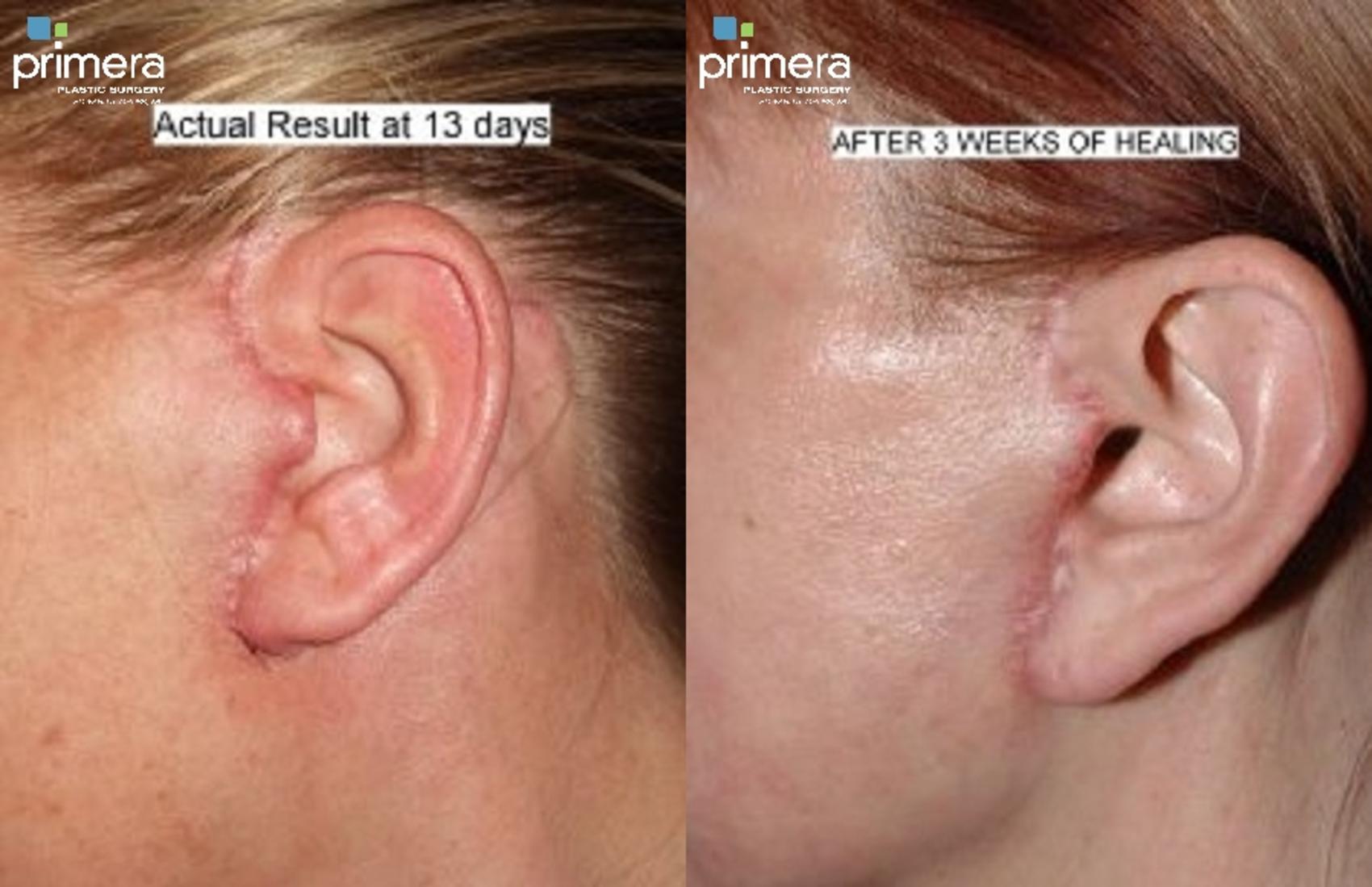 Before & After Mini Facelift Case 313 view-1 View in Orlando, Florida