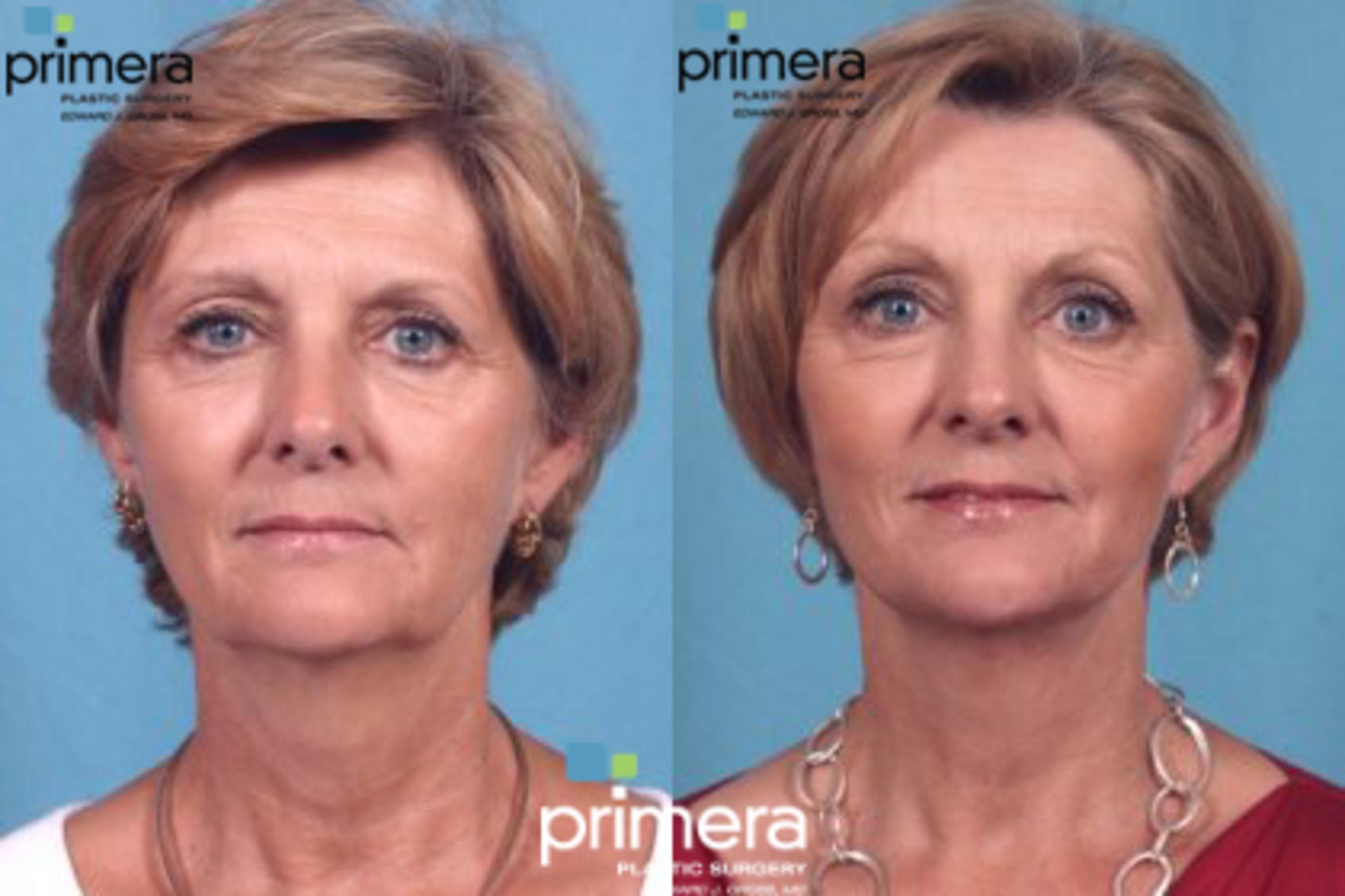 Mini Facelift Before After Photo Gallery Orlando Florida Primera Plastic Surgery