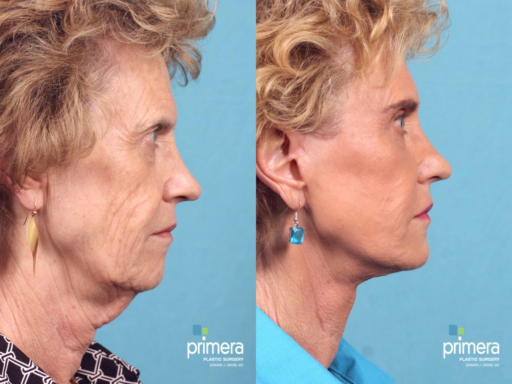 Before & After Laser Skin Resurfacing (DOT CO2) Case 370 view-1 View in Orlando, Winter Park & Tampa, Florida