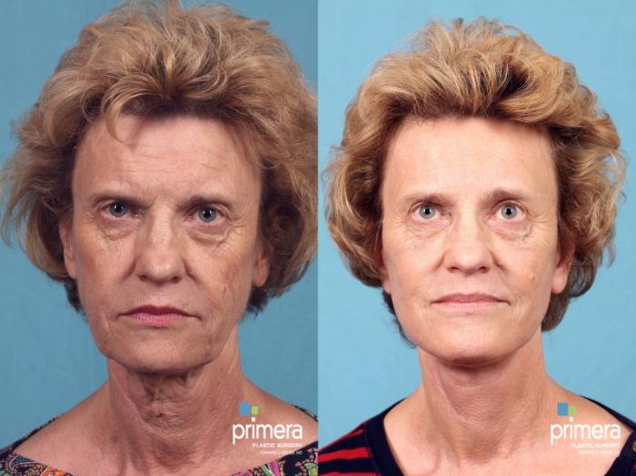 Before & After Endoscopic Forehead Lift Case 370 view-2 View in Orlando, Florida