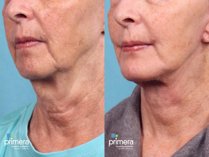 Before & After Chin & Cheek Implant Case 371 view-1 View in Orlando, Florida